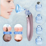 Removedor de Espinillas y Puntos Negros